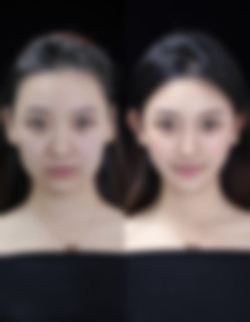 一、割双眼皮第五天伤口痒通常是咋回事