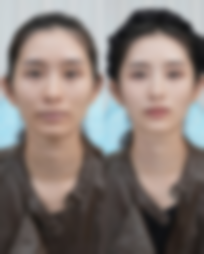 二、割双眼皮第五天伤口痒该怎么应对