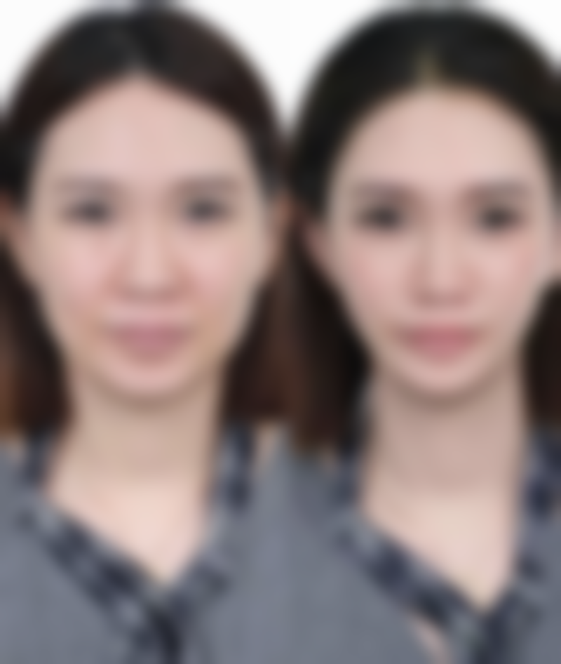 三、结合个体差异判断做完双眼皮月经期能否拆线