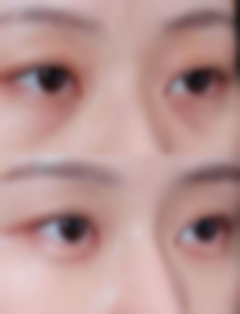 五、不同人群割双眼皮第五天伤口痒的特殊注意事项