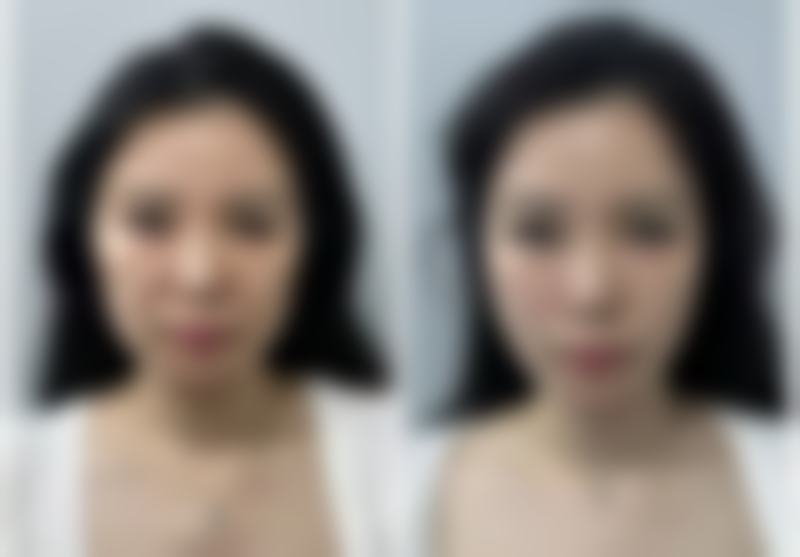 做完双眼皮月经期可以拆线吗?了解生理期拆线风险与注意事项，附相关图片参考 