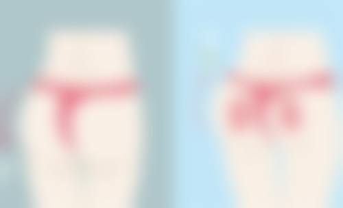 三、怎么快速有效消除眼袋之手术治疗法