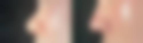 三、膨体隆鼻的优缺点及适用人群