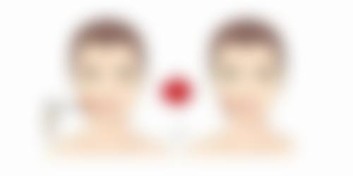 内切眼袋多久消肿祛瘀？恢复时间大揭秘，教你加速眼周恢复进程 