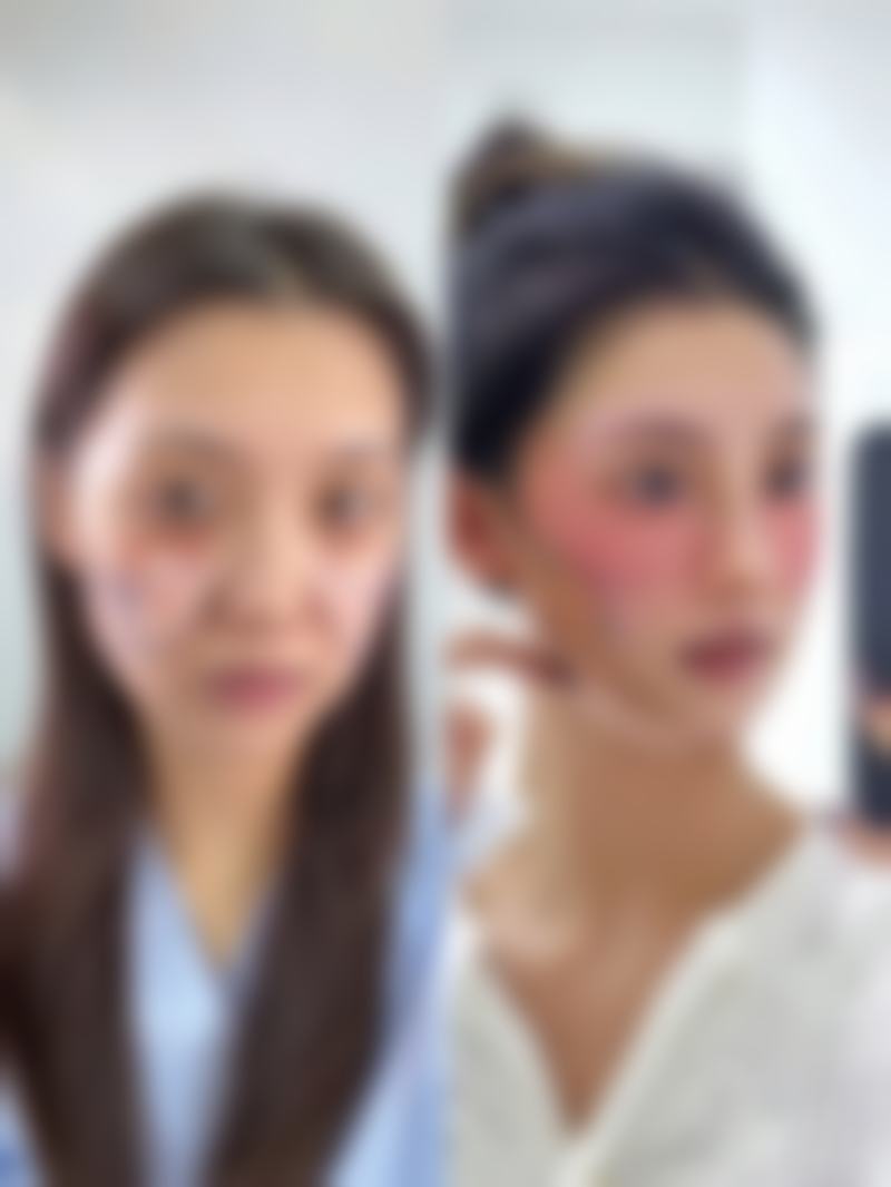 五、选择硅胶或膨体隆鼻的其他注意事项