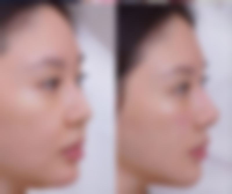 三、开眼角割双眼皮的修复阶段