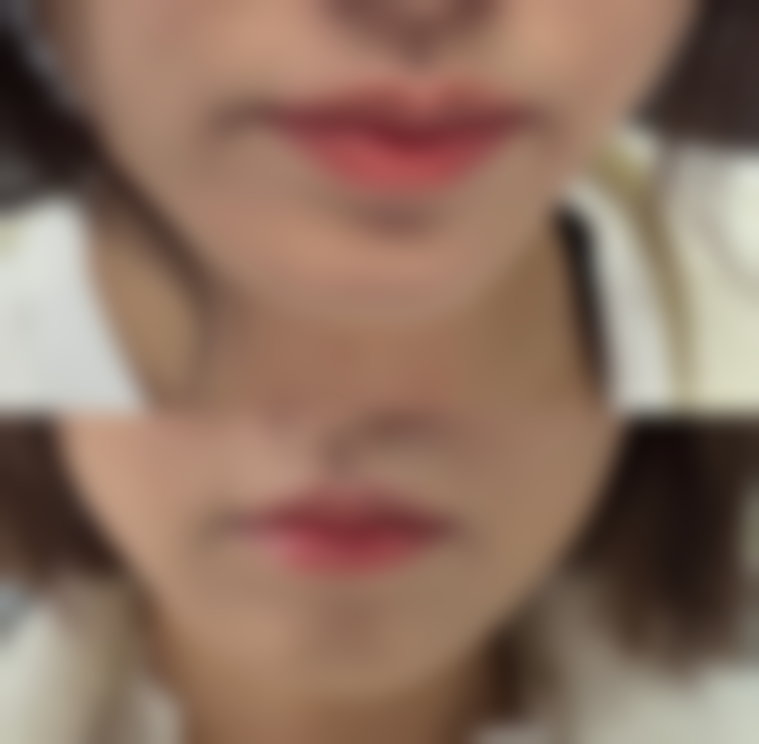 眼部注射除皱都用什么针？肉毒素、玻尿酸等多方案为你揭晓眼部抗衰密码 