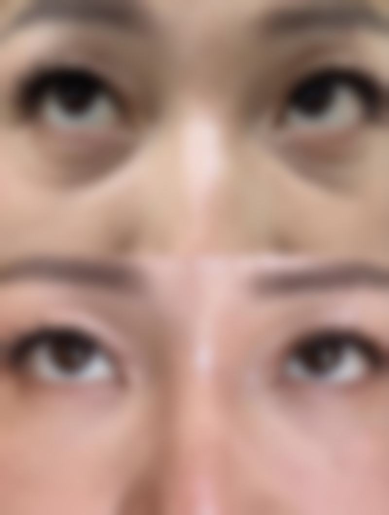 二、频繁注射除皱针对面部外观的危害