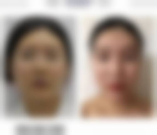 四、怎么消除眼袋简单的——总结与建议