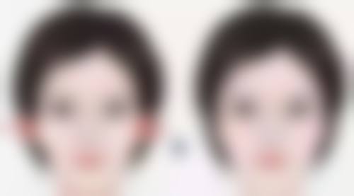 五、为什么抽脂手术特别危险之降低风险的关键