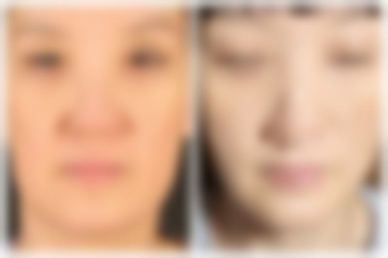 四、为什么抽脂手术特别危险之美学注意事项