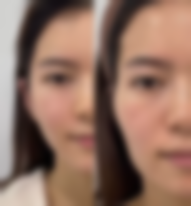 怎么消除眼袋简单的？日常护理与医美手段结合，这些简单方法别错过！ 