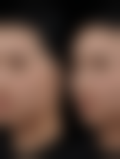 德国热熔眼袋技术怎样？揭秘其操作方法、效果与优势，让你告别眼袋烦恼 