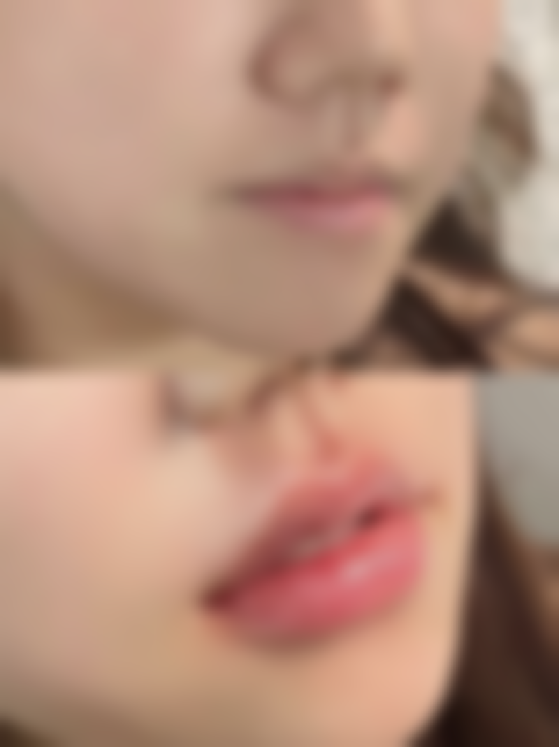 三、激光脱毛对疤痕体质皮肤的潜在影响