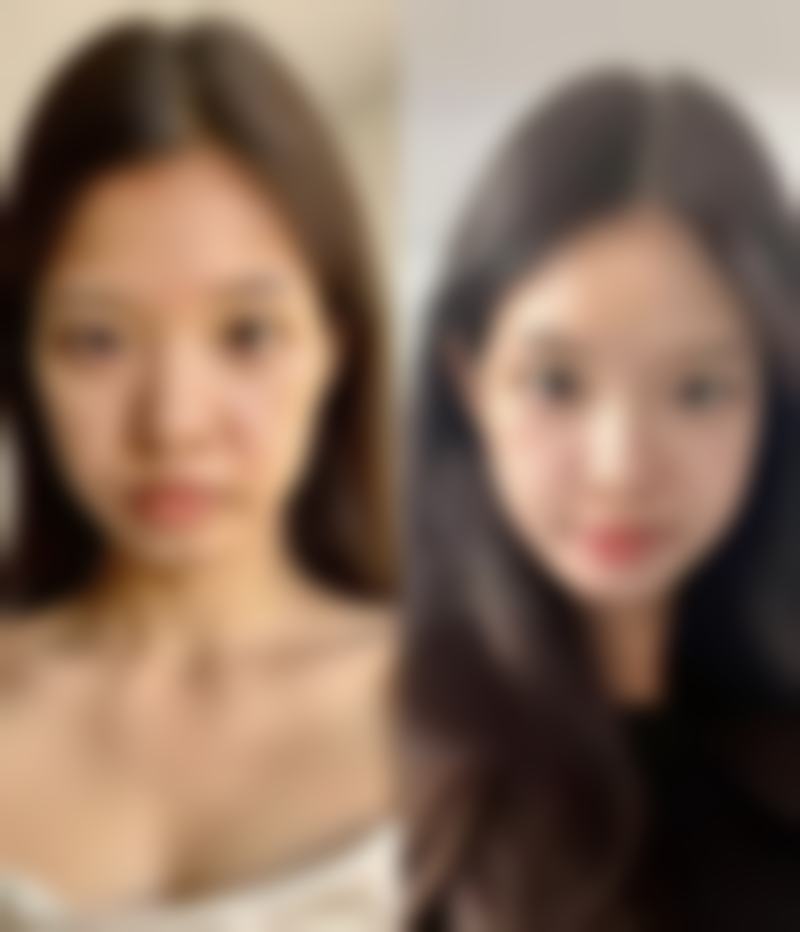 四、双眼皮增生的美学与修复建议