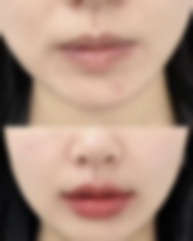 三、使用芦荟涂脸及淡化疤痕的注意事项