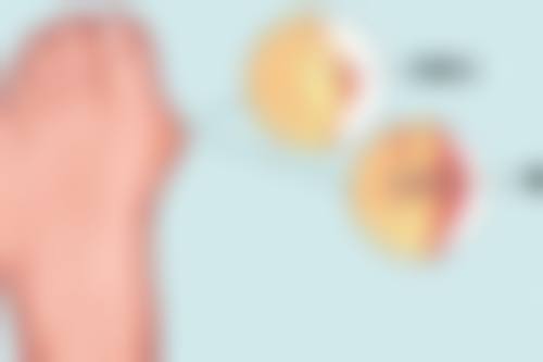 一、为什么做完双眼皮上眼皮显得厚：常见原因分析