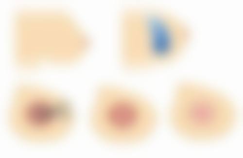 三、瘦脸针不同时间段的表现和注意事项