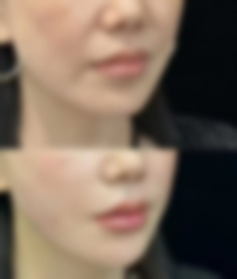 五、吸脂后做射频紧肤的成效与风险