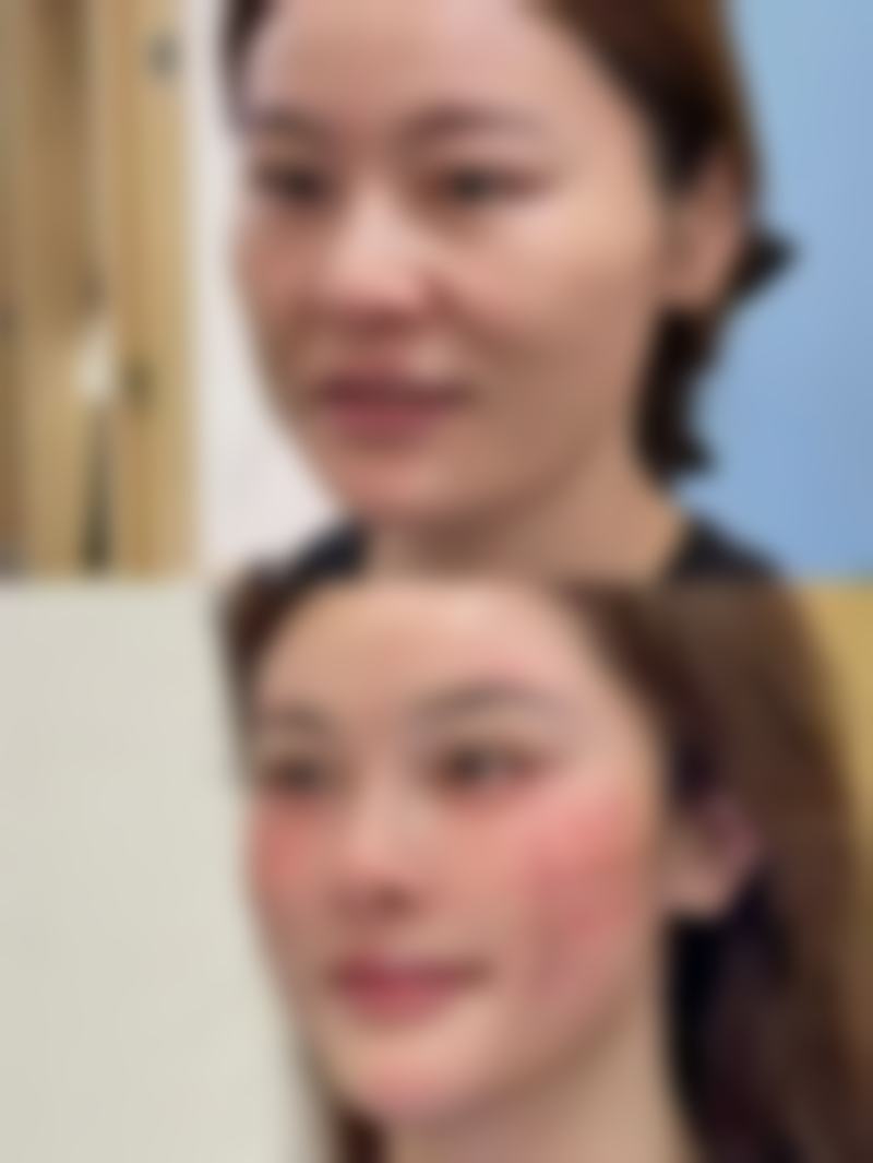 四、其他因素对双眼皮深浅的影响