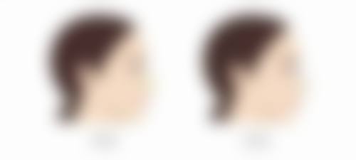 一、隆胸能保持多少年？常见隆胸方式成效维持时长