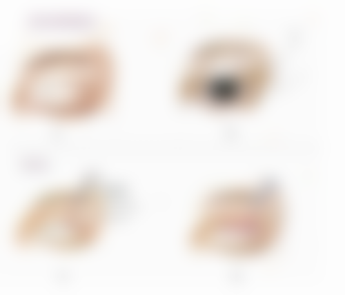 四、如何延长埋线双眼皮的成效