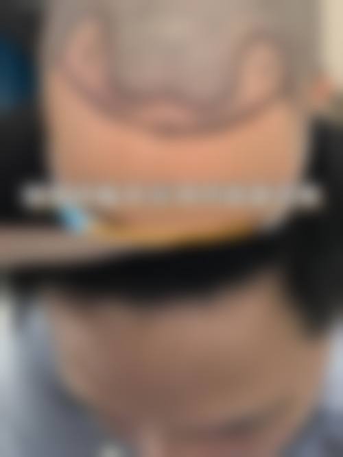 七、厦门碧莲盛无痕植发整形预约方式