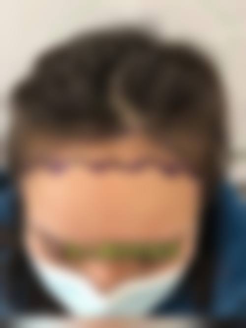 八、厦门碧莲盛无痕植发整形真实的患者评价