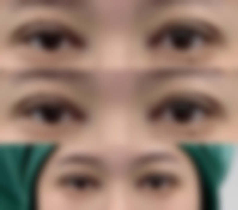 三、区分普通疤痕与疤痕体质相关疤痕