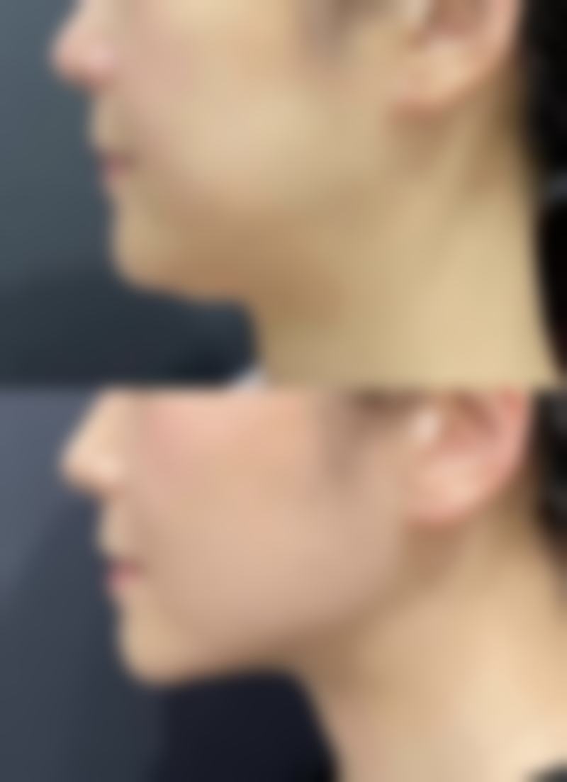 一、认识疤痕增生