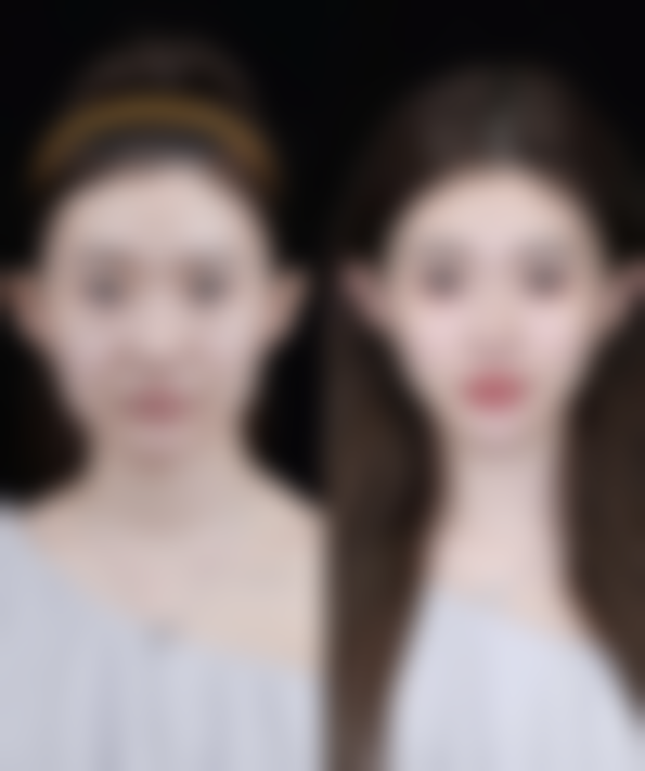 假体隆胸多少年以后要取出来？多因素决定取出时间，早了解早安心！ 