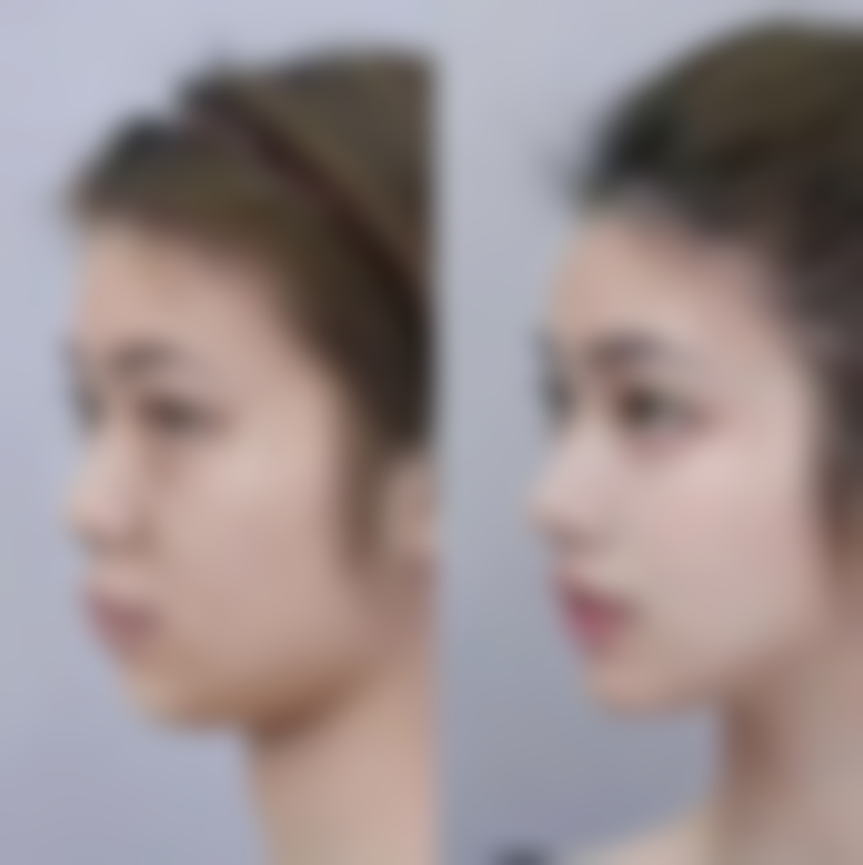 经期做了埋线双眼皮怎么办？掌握这些护理要点让你恢复快收获漂亮双眼皮！ 