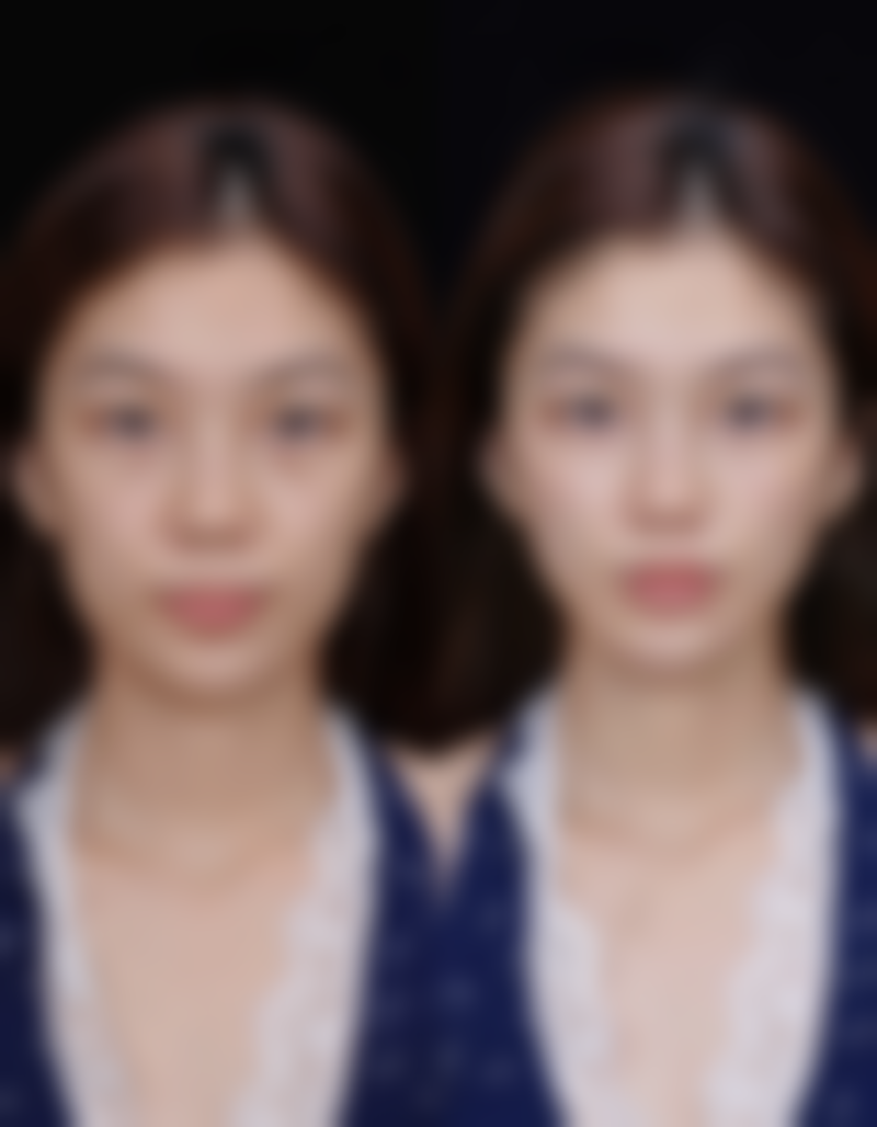 一、疤痕体质的定义和基本特征