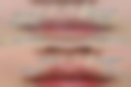 一、眼袋手术修复期概述