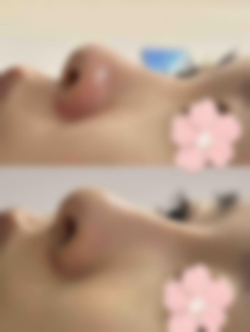 如何治疗烫伤留下疤痕？药物、激光、手术等多方法助你有效修复疤痕 