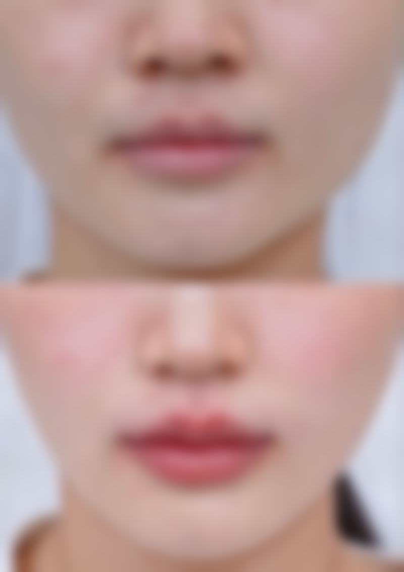 二、内双怎么变成双眼皮呢小窍门之手术方法