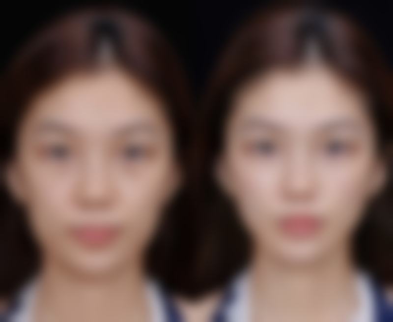 面部疤痕怎么淡化最快？掌握医美手段与日常护理秘诀，让疤痕快速淡化！ 