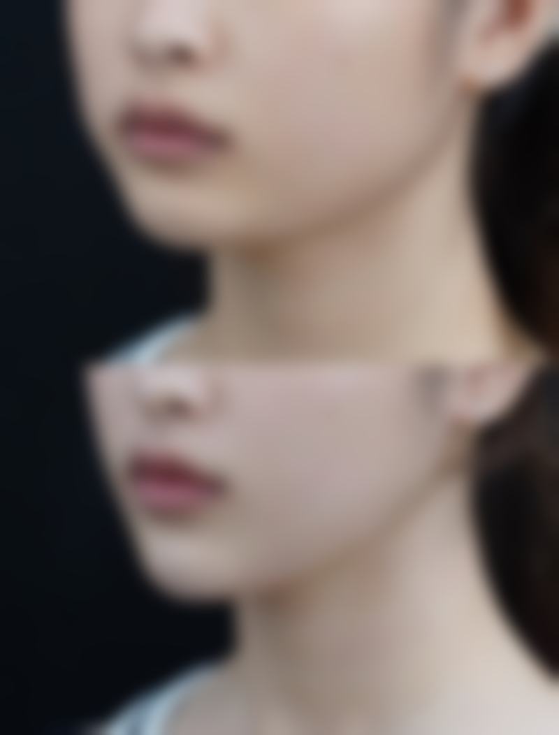 四、其他改善手术方法