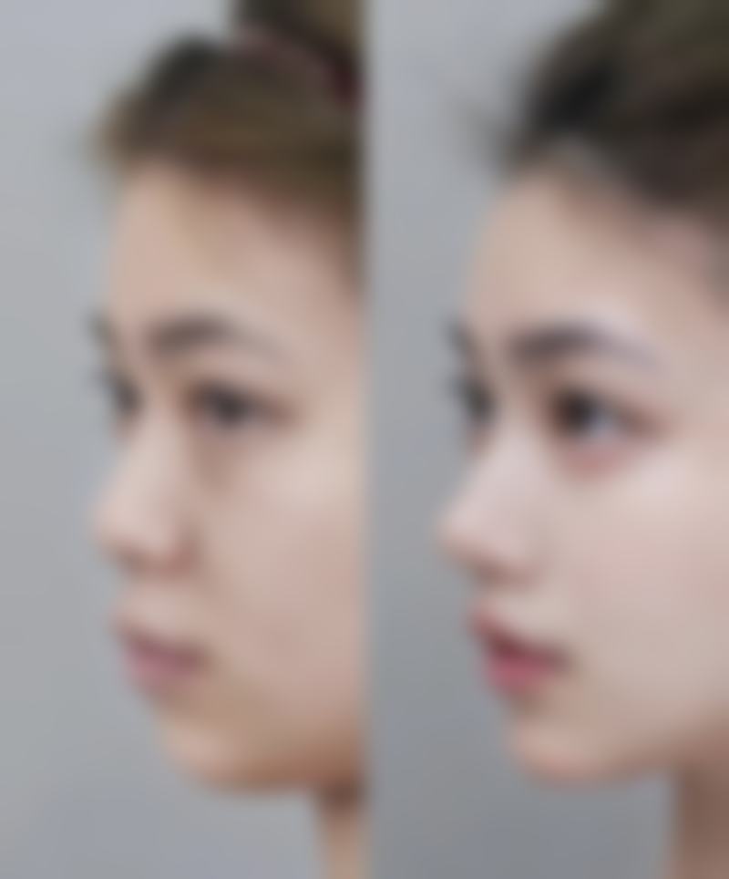 一、不开刀去眼袋的可行性分析