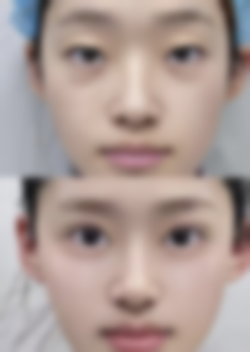 割眼袋眼睛青了一圈怎么办？分阶段护理、医疗手段助你加速恢复（附处理图片） 