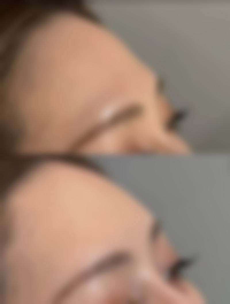 三、非手术与手术改善眼袋对比