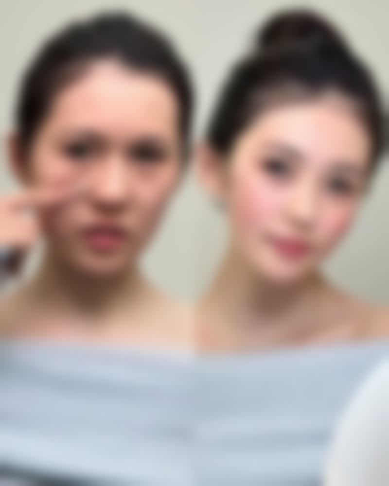 五、如何判断眼袋类型