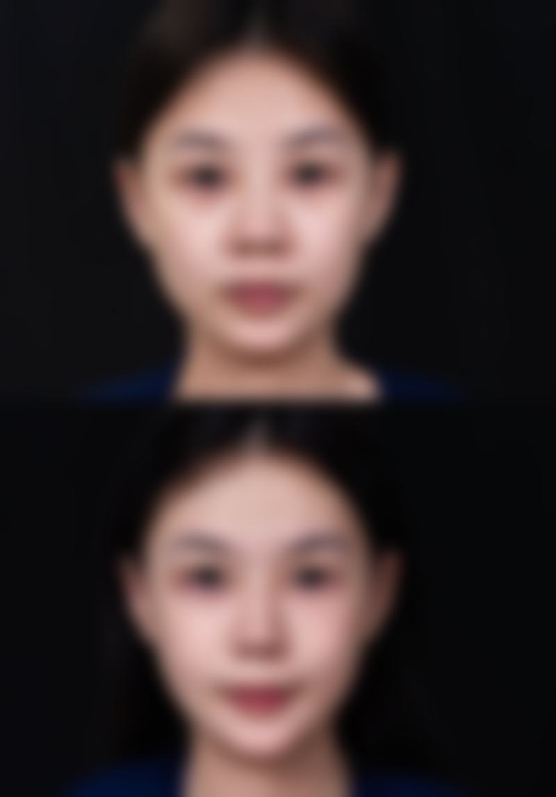 二、促进熬夜熬出的眼袋修复的方法