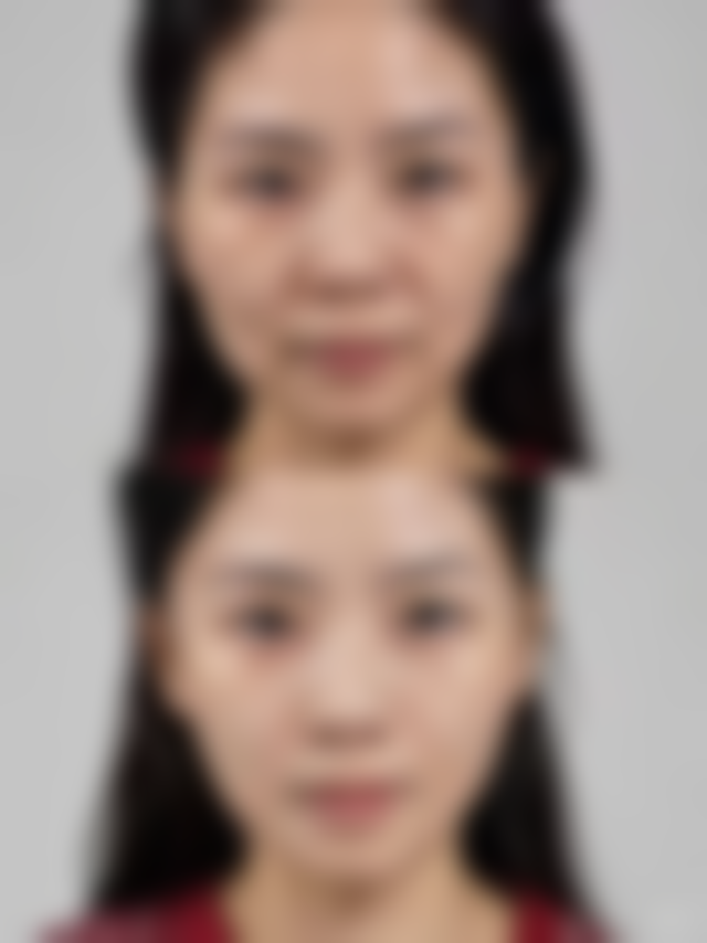 黑眼圈眼袋泪沟做什么医美？常见项目效果、恢复期及维持时间全揭秘！ 