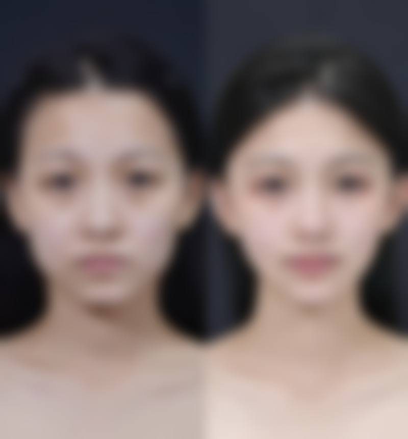 四、黄瓜可以除眼袋吗？科学应对眼袋的医美方案