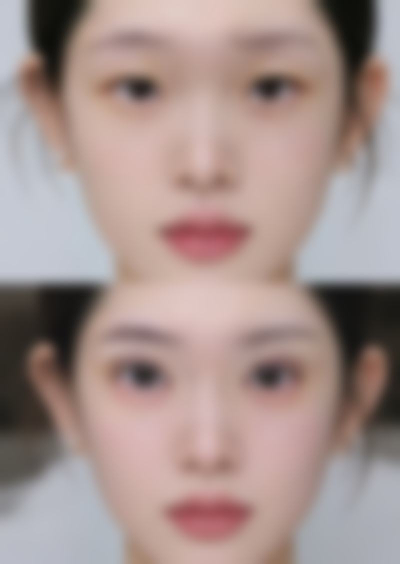 种植发自己的毛囊不够怎么办？多种方案助你应对毛囊不足难题焕新形象