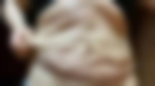 三、大腿抽脂的其他注意事项