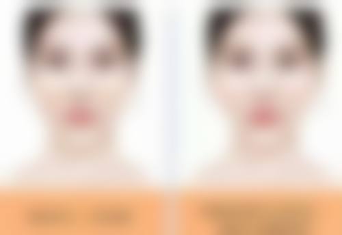 二、去除眼袋下脂肪粒的医美手段