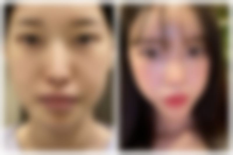 大腿抽脂能瘦多少斤？抽脂量与个体差异影响结果，术后塑形裤要穿半年！ 