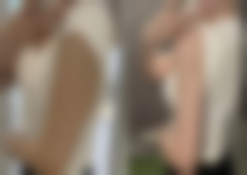 一、割双眼皮后戴美瞳的时间